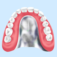 金属床（チタン・コバルトクロム）義歯